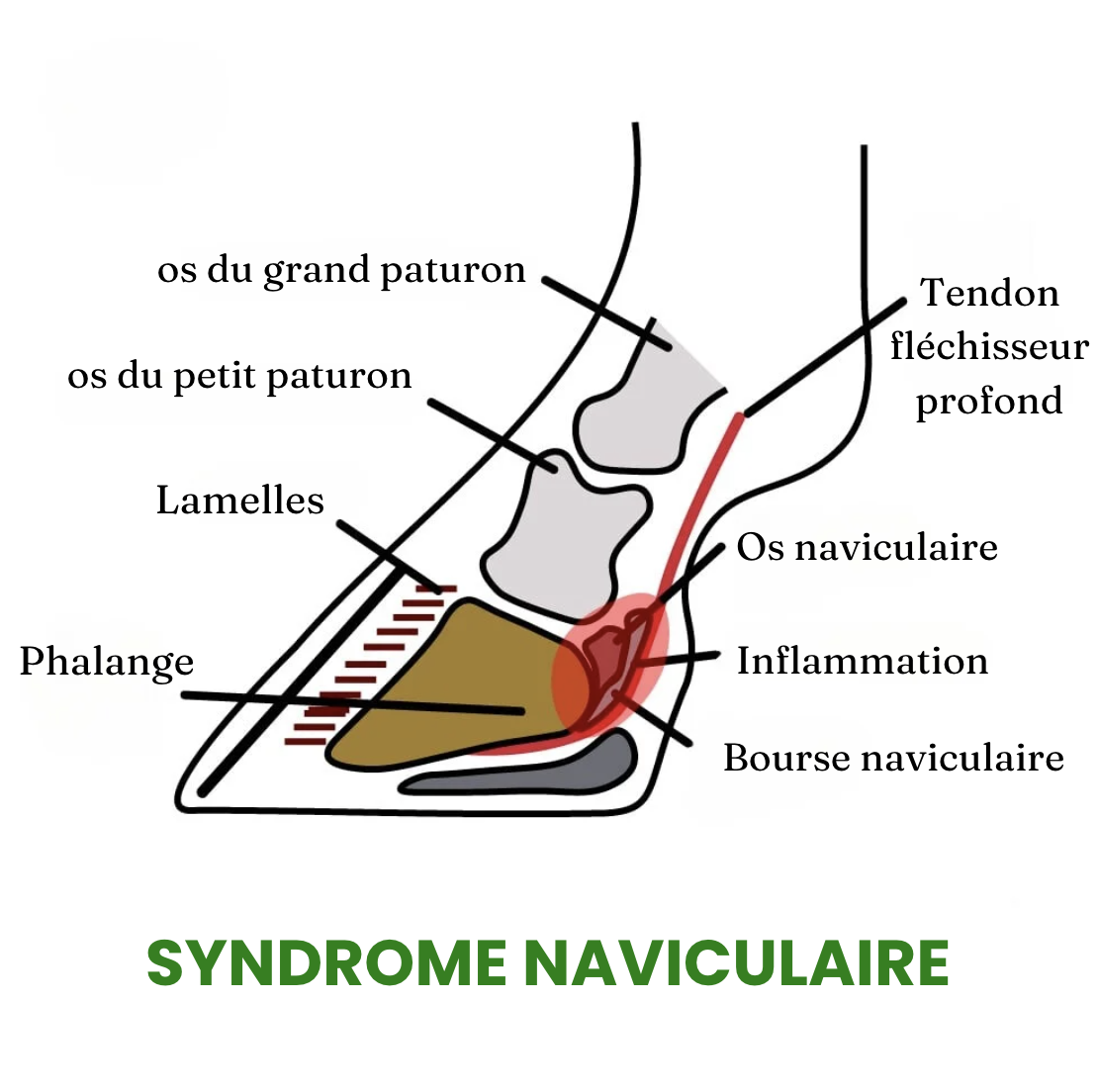 Schéma du syndrome naviculaire